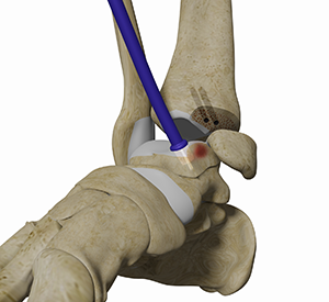 Osteochondral Autograft Transplantation System (OATS) of the Ankle