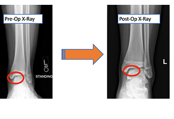 Osteochondral Lesions