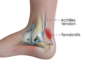 Achillles Tendinitis or Tendinosis