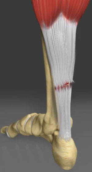 Achilles Tendon Rupture Repair