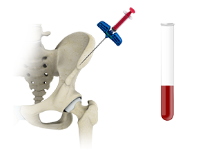 Concentrated Bone Marrow Aspirate (CBMA)