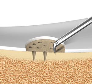 Bone Marrow Stimulation