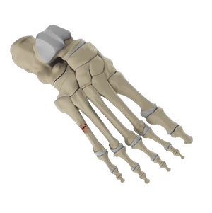 Fifth Metatarsal Fractures: Jones Fracture 