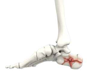 Foot Fracture