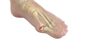 Hallux Rigidus: Stiff Big Toe