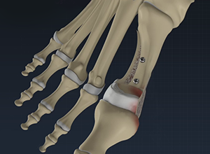 Hallux Valgus: Bunion