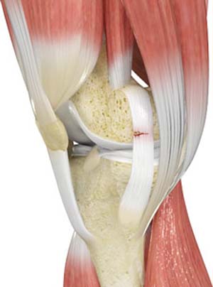 Ankle Fractures