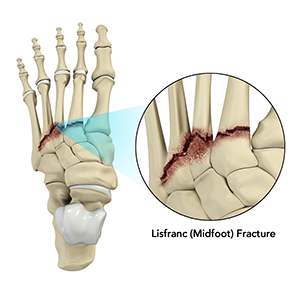 Lisfranc (Midfoot) Injury