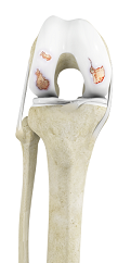 Ankle Fractures