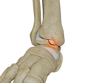 Osteochondral Injuries of the Ankle