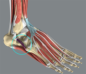 Peroneal Tendinitis and Dislocatio