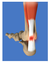 Achilles Pathologies