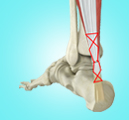 Achilles Tendon Rupture Repair