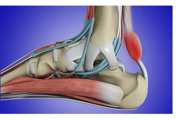 Achilles Tendonitis/Tendonosis/Repair