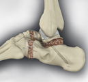 Ankle Fusion