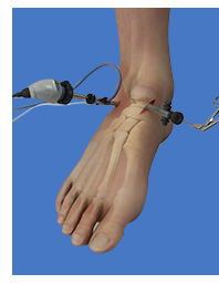 Foot & Ankle Arthroscopy