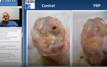 Biological Enhancement in the Treatment of Osteochondral Lesions of the Talus