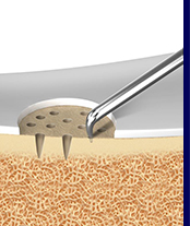 Bone Marrow Stimulation