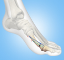Bunion Surgery
