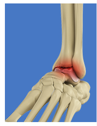 Foot and Ankle Arthritis