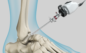 Foot & Ankle Arthroscopy