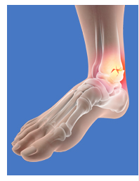 Fractures of the Foot and Ankle