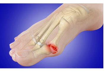 Hallux Rigidus/Hallux Valgus