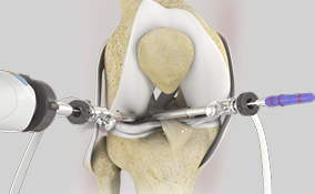 Knee Arthroscopy