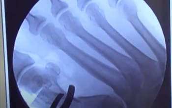 Modified Rotational Scarf Osteotomy for Hallux Valgus VuMedi 
