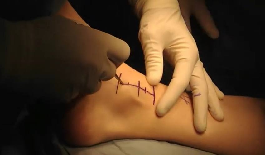 Osteochondral Allograft Transplantation System