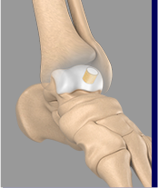 Autologous Osteochondral Transplantation