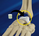 Trapdoor Procedure for Osteochondritis Dissecans