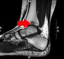 Tibial Osteochondral Lesion