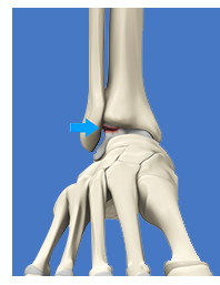 Osteochondral Lesions