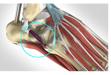 Posterior Tibial Tendon Insufficiency