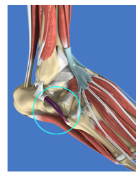 Peroneal Tendonitis and
Posterior Tib Tendonitis