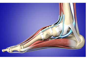 Posterior Tibial Tendon Insufficiency