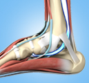 Posterior Tibial Tendon Dysfunction