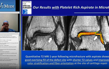 PRP for Cartilage in the Ankle VuMedi 