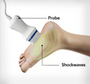 Shockwave Therapy