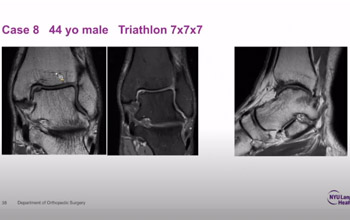 What's New in Foot and Ankle Surgery Needle Arthroscopy Nano Technology How Can It Facilitate Diag 